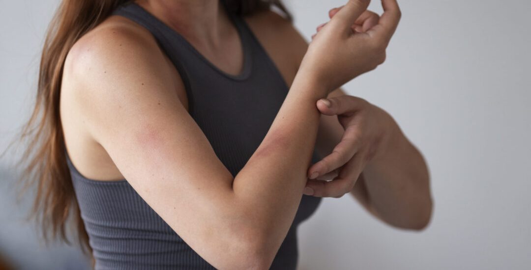 mujer-que-sufre-de-erupcion